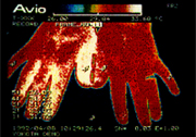スーパーライザー照射による両手皮膚温の上昇